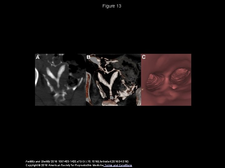 Figure 13 Fertility and Sterility 2016 1051403 -1420. e 7 DOI: (10. 1016/j. fertnstert.