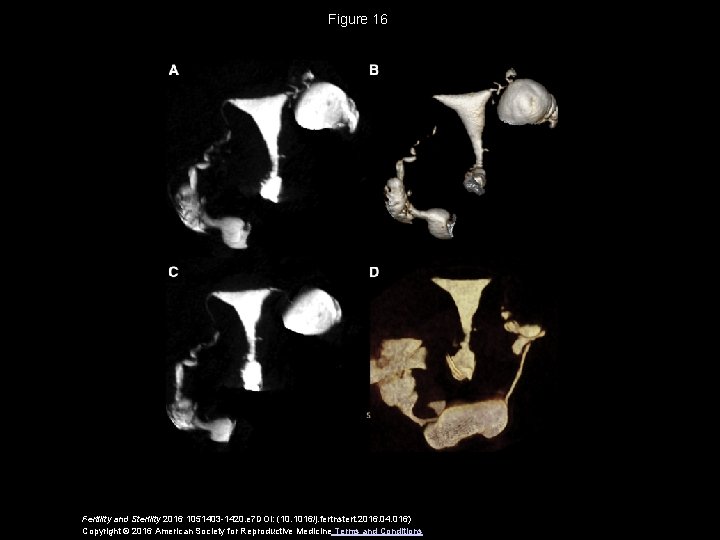 Figure 16 Fertility and Sterility 2016 1051403 -1420. e 7 DOI: (10. 1016/j. fertnstert.