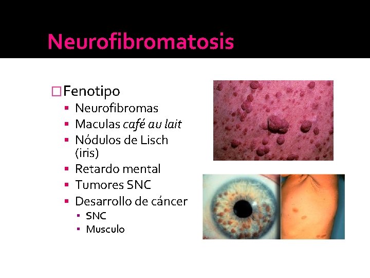 Neurofibromatosis �Fenotipo Neurofibromas Maculas café au lait Nódulos de Lisch (iris) Retardo mental Tumores Neurofibromatosis �Fenotipo Neurofibromas Maculas café au lait Nódulos de Lisch (iris) Retardo mental Tumores