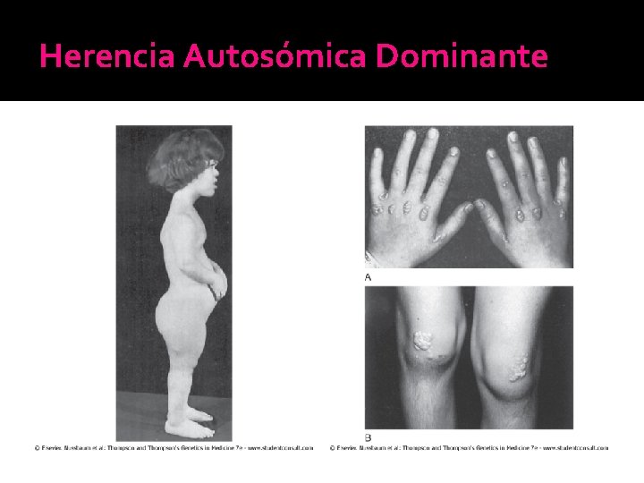Herencia Autosómica Dominante Herencia Autosómica Dominante