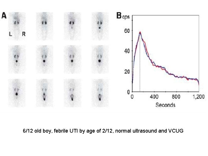 6/12 old boy, febrile UTI by age of 2/12, normal ultrasound and VCUG 