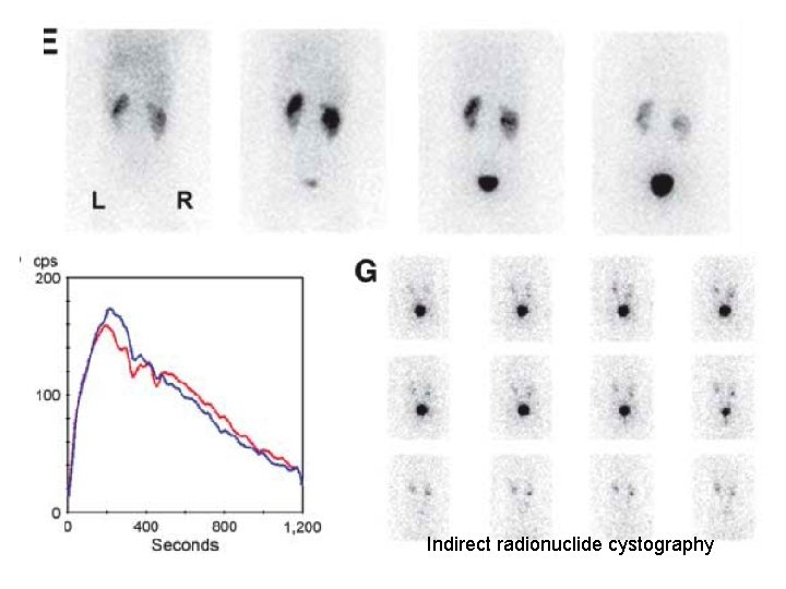 Indirect radionuclide cystography 