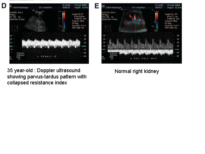 35 year-old : Doppler ultrasound showing parvus-tardus pattern with collapsed resistance index Normal right