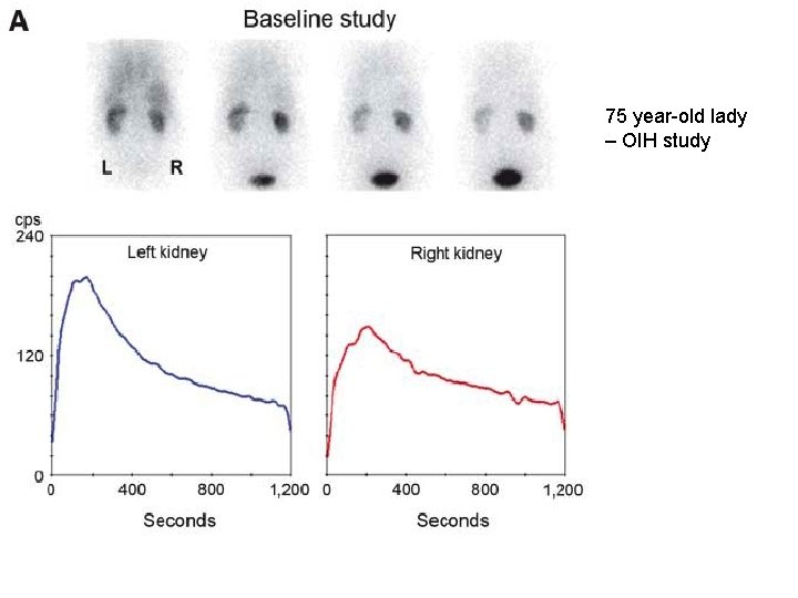 75 year-old lady – OIH study 