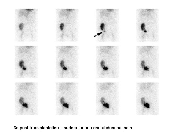 6 d post-transplantation – sudden anuria and abdominal pain 
