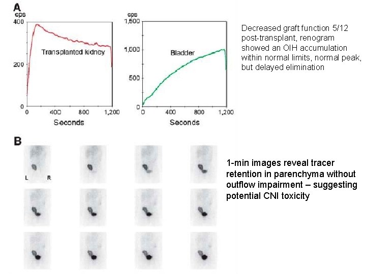 Decreased graft function 5/12 post-transplant, renogram showed an OIH accumulation within normal limits, normal