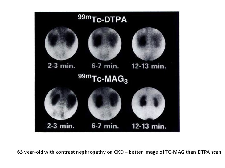 65 year-old with contrast nephropathy on CKD – better image of TC-MAG than DTPA