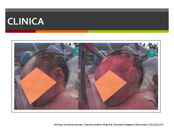 CLINICA Chinsky; Hydranencephaly: Transillumination May Not Illuminate Diagnosis Neoreviews 2012; 13; e 233 CLINICA Chinsky; Hydranencephaly: Transillumination May Not Illuminate Diagnosis Neoreviews 2012; 13; e 233