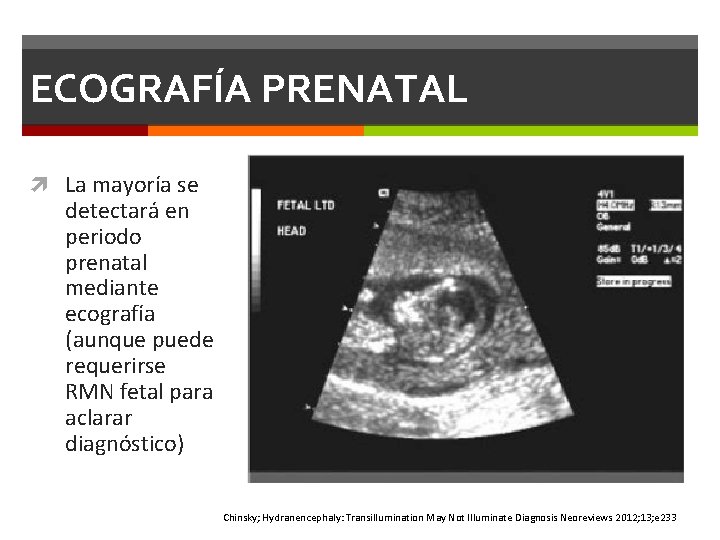 ECOGRAFÍA PRENATAL La mayoría se detectará en periodo prenatal mediante ecografía (aunque puede requerirse ECOGRAFÍA PRENATAL La mayoría se detectará en periodo prenatal mediante ecografía (aunque puede requerirse