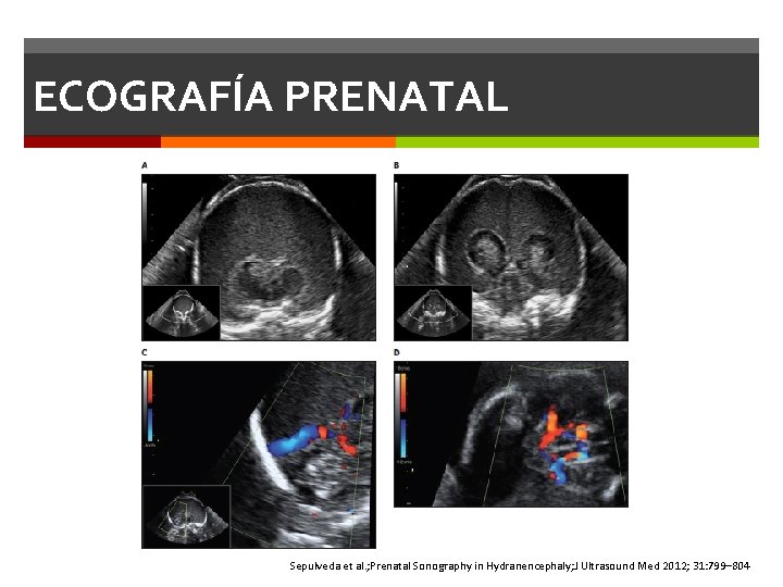 ECOGRAFÍA PRENATAL Sepulveda et al. ; Prenatal Sonography in Hydranencephaly; J Ultrasound Med 2012; ECOGRAFÍA PRENATAL Sepulveda et al. ; Prenatal Sonography in Hydranencephaly; J Ultrasound Med 2012;