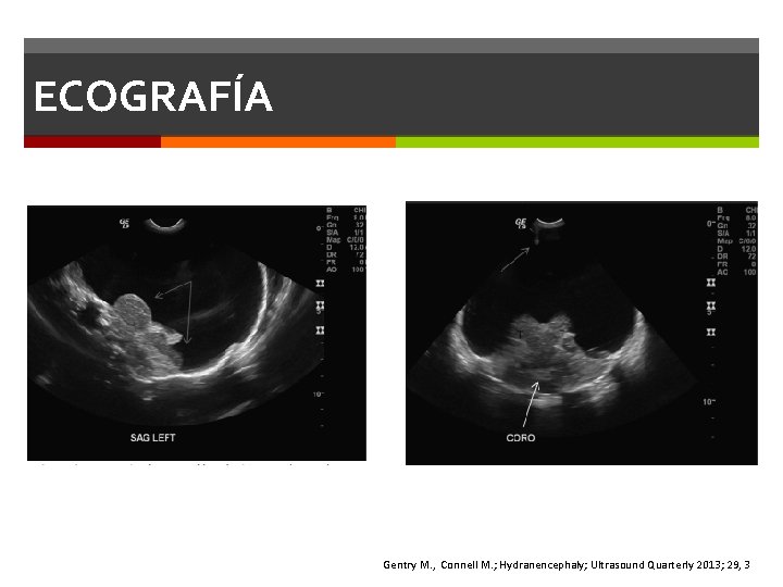 ECOGRAFÍA Gentry M. , Connell M. ; Hydranencephaly; Ultrasound Quarterly 2013; 29, 3 ECOGRAFÍA Gentry M. , Connell M. ; Hydranencephaly; Ultrasound Quarterly 2013; 29, 3