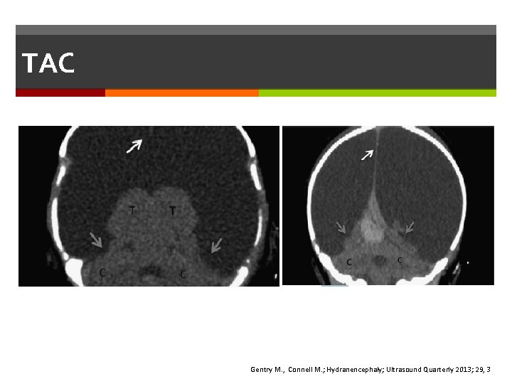 TAC Gentry M. , Connell M. ; Hydranencephaly; Ultrasound Quarterly 2013; 29, 3 TAC Gentry M. , Connell M. ; Hydranencephaly; Ultrasound Quarterly 2013; 29, 3