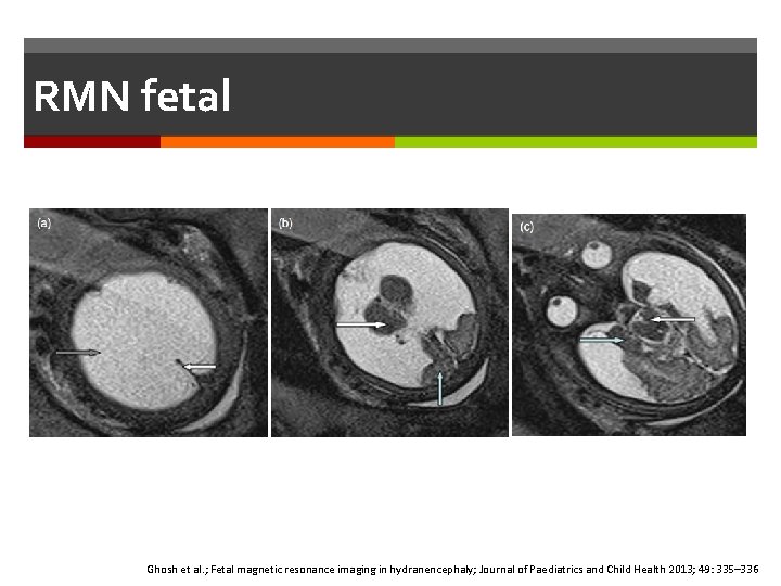 RMN fetal Ghosh et al. ; Fetal magnetic resonance imaging in hydranencephaly; Journal of RMN fetal Ghosh et al. ; Fetal magnetic resonance imaging in hydranencephaly; Journal of