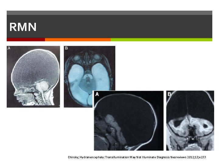 RMN Chinsky; Hydranencephaly: Transillumination May Not Illuminate Diagnosis Neoreviews 2012; 13; e 233 RMN Chinsky; Hydranencephaly: Transillumination May Not Illuminate Diagnosis Neoreviews 2012; 13; e 233