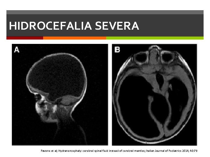 HIDROCEFALIA SEVERA Pavone et al; Hydranencephaly: cerebral spinal fluid instead of cerebral mantles; Italian HIDROCEFALIA SEVERA Pavone et al; Hydranencephaly: cerebral spinal fluid instead of cerebral mantles; Italian