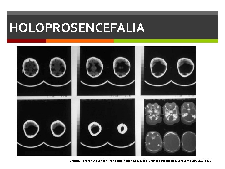 HOLOPROSENCEFALIA Chinsky; Hydranencephaly: Transillumination May Not Illuminate Diagnosis Neoreviews 2012; 13; e 233 HOLOPROSENCEFALIA Chinsky; Hydranencephaly: Transillumination May Not Illuminate Diagnosis Neoreviews 2012; 13; e 233