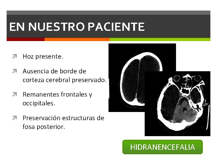 EN NUESTRO PACIENTE Hoz presente. Ausencia de borde de corteza cerebral preservado. Remanentes frontales EN NUESTRO PACIENTE Hoz presente. Ausencia de borde de corteza cerebral preservado. Remanentes frontales