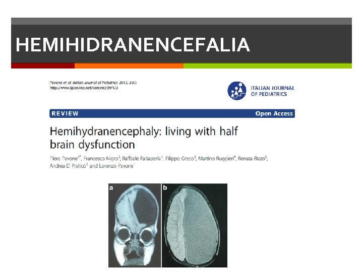 HEMIHIDRANENCEFALIA HEMIHIDRANENCEFALIA