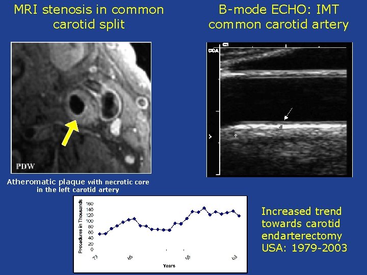 MRI stenosis in common carotid split B-mode ECHO: IMT common carotid artery Atheromatic plaque