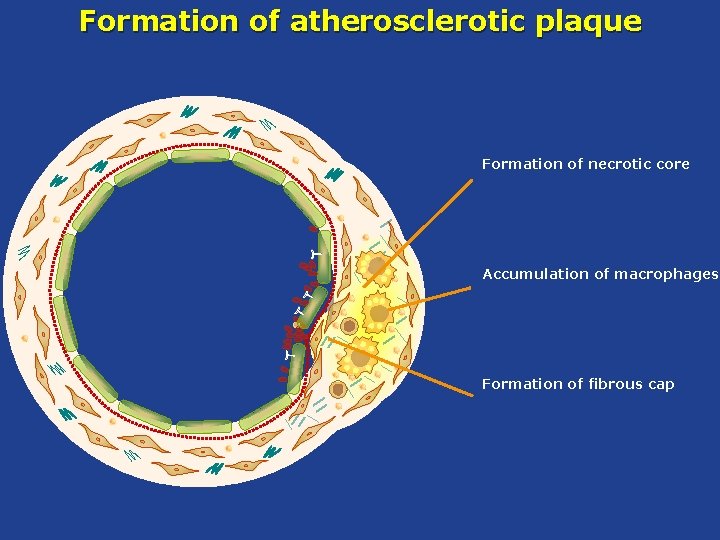 Formation of atherosclerotic plaque Formation of necrotic core Accumulation of macrophages Formation of fibrous