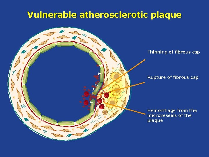 Vulnerable atherosclerotic plaque Thinning of fibrous cap Rupture of fibrous cap Hemorrhage from the