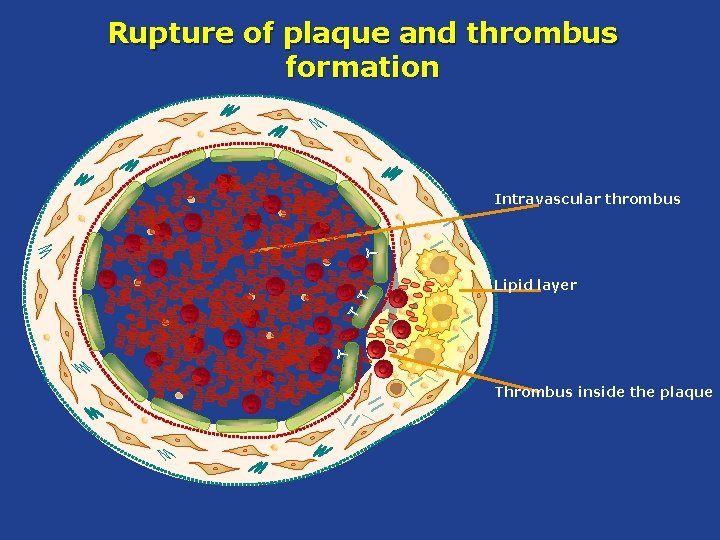 Rupture of plaque and thrombus formation Intravascular thrombus Lipid layer Thrombus inside the plaque