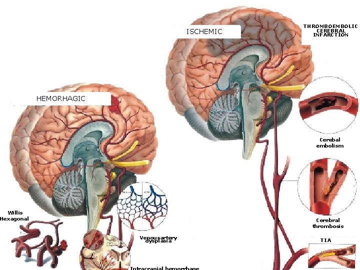 ISCHEMIC THROMBOEMBOLIC CEREBRAL INFARCTION HEMORHAGIC Cerebal embolism Willis Hexagonal Cerebral thrombosis Venousartery dysplasia TIA