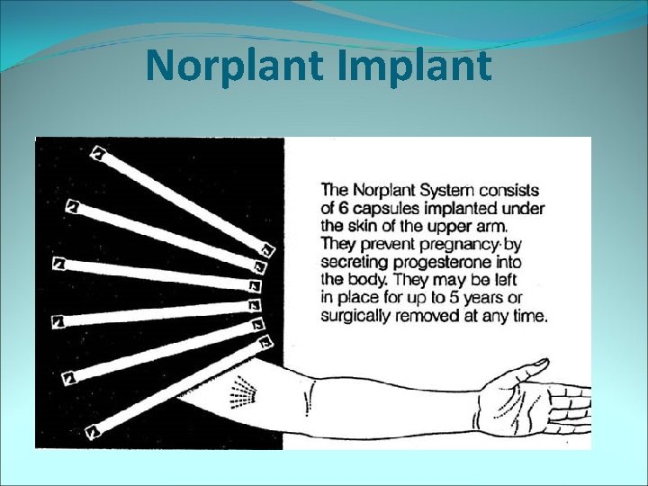 Norplant Implant 