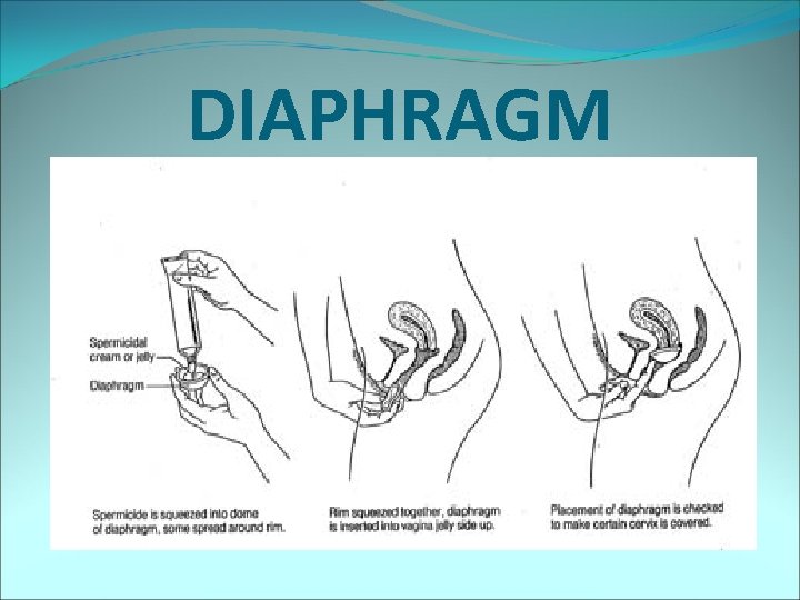 DIAPHRAGM 