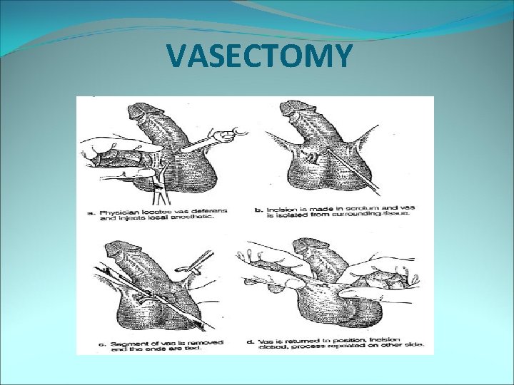 VASECTOMY 