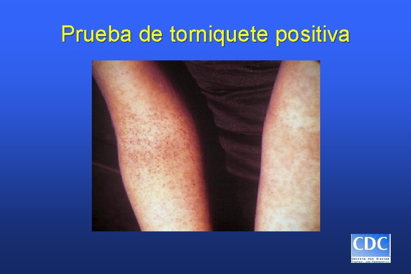 Prueba de torniquete positiva 