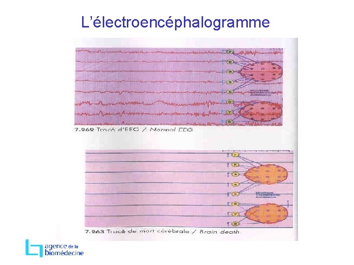 L’électroencéphalogramme 