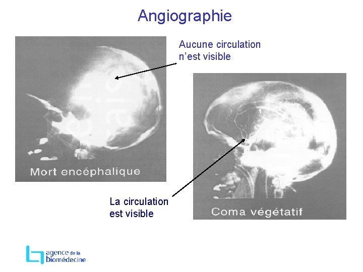 Angiographie Aucune circulation n’est visible La circulation est visible 