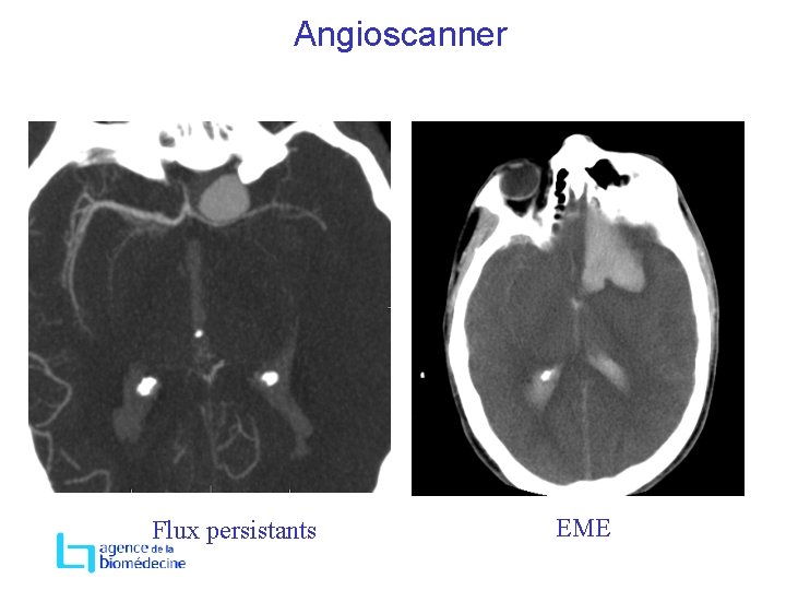 Angioscanner Flux persistants EME 