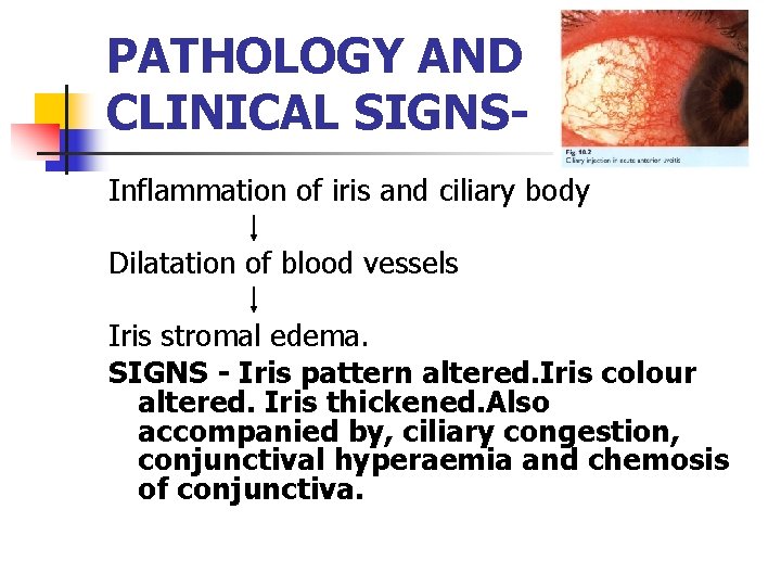 PATHOLOGY AND CLINICAL SIGNSInflammation of iris and ciliary body Dilatation of blood vessels Iris PATHOLOGY AND CLINICAL SIGNSInflammation of iris and ciliary body Dilatation of blood vessels Iris