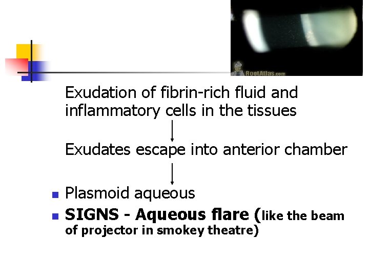 Exudation of fibrin-rich fluid and inflammatory cells in the tissues Exudates escape into anterior Exudation of fibrin-rich fluid and inflammatory cells in the tissues Exudates escape into anterior