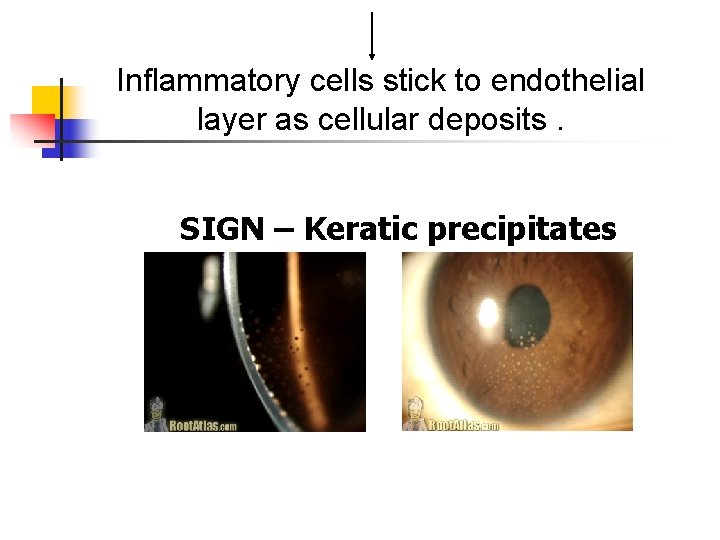 Inflammatory cells stick to endothelial layer as cellular deposits. SIGN – Keratic precipitates Inflammatory cells stick to endothelial layer as cellular deposits. SIGN – Keratic precipitates