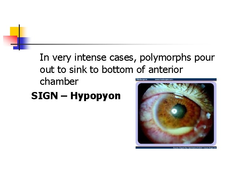 In very intense cases, polymorphs pour out to sink to bottom of anterior chamber In very intense cases, polymorphs pour out to sink to bottom of anterior chamber