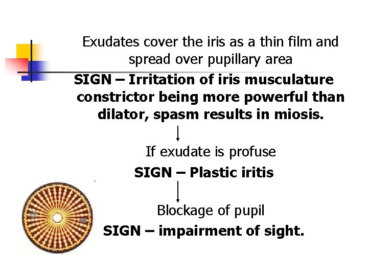 Exudates cover the iris as a thin film and spread over pupillary area SIGN Exudates cover the iris as a thin film and spread over pupillary area SIGN