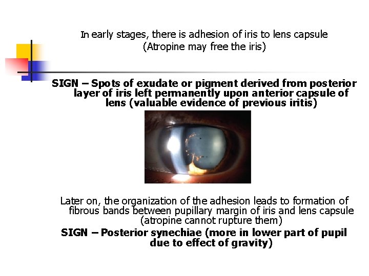 In early stages, there is adhesion of iris to lens capsule (Atropine may free In early stages, there is adhesion of iris to lens capsule (Atropine may free