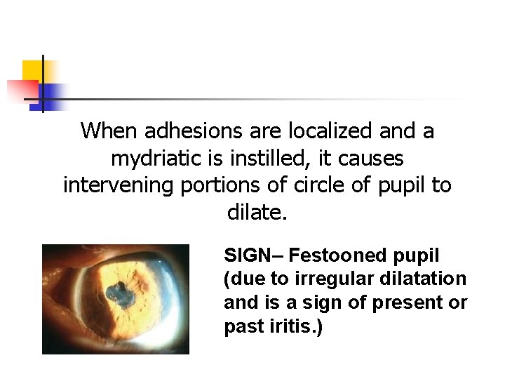 When adhesions are localized and a mydriatic is instilled, it causes intervening portions of When adhesions are localized and a mydriatic is instilled, it causes intervening portions of