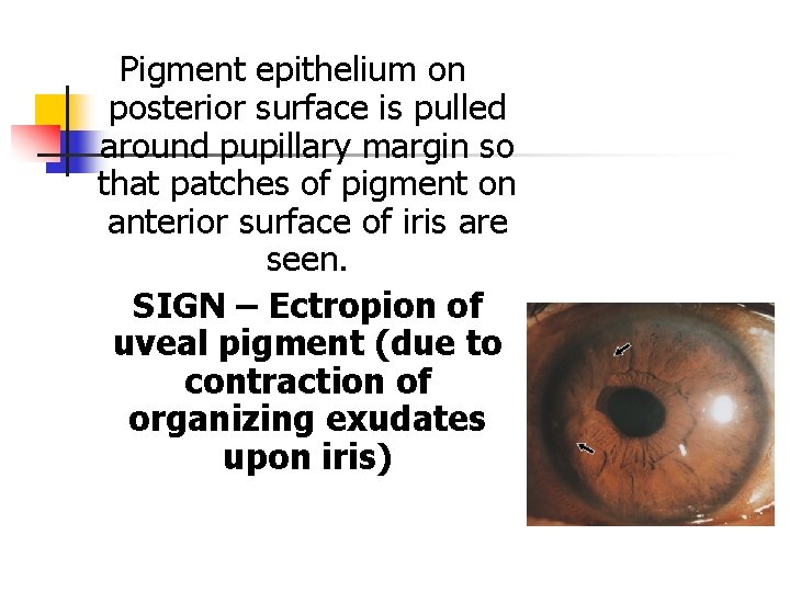 Pigment epithelium on posterior surface is pulled around pupillary margin so that patches of Pigment epithelium on posterior surface is pulled around pupillary margin so that patches of