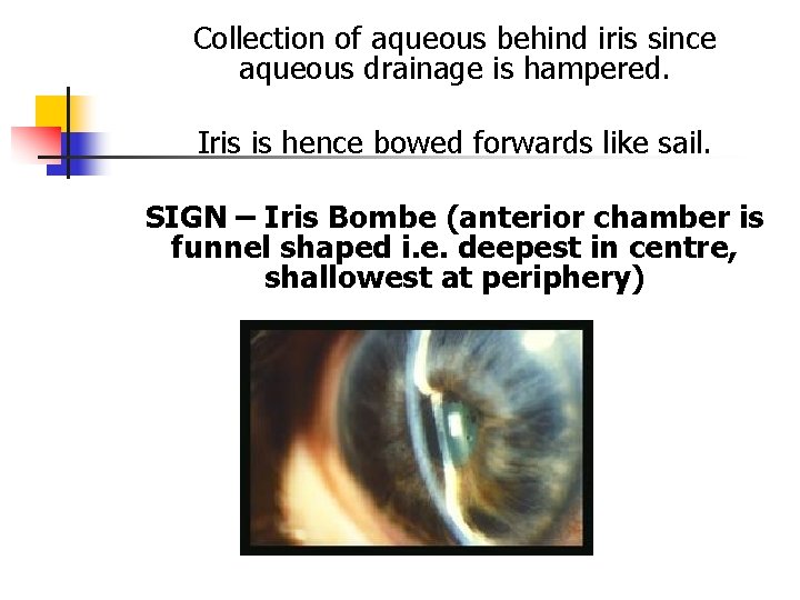 Collection of aqueous behind iris since aqueous drainage is hampered. Iris is hence bowed Collection of aqueous behind iris since aqueous drainage is hampered. Iris is hence bowed