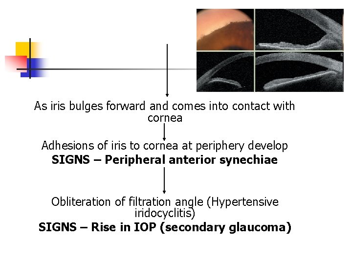 As iris bulges forward and comes into contact with cornea Adhesions of iris to As iris bulges forward and comes into contact with cornea Adhesions of iris to