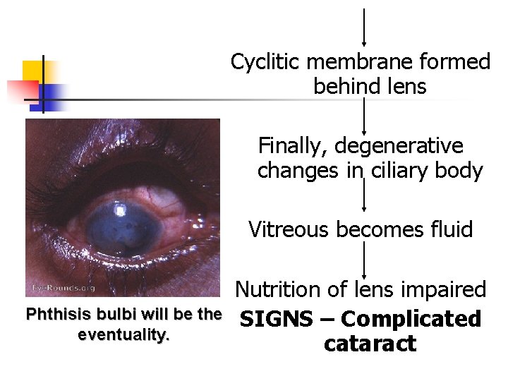 Cyclitic membrane formed behind lens Finally, degenerative changes in ciliary body Vitreous becomes fluid Cyclitic membrane formed behind lens Finally, degenerative changes in ciliary body Vitreous becomes fluid