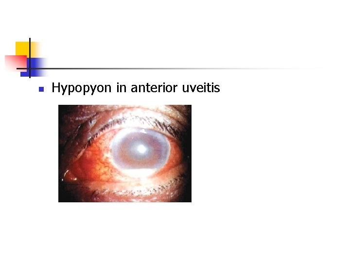 n Hypopyon in anterior uveitis n Hypopyon in anterior uveitis