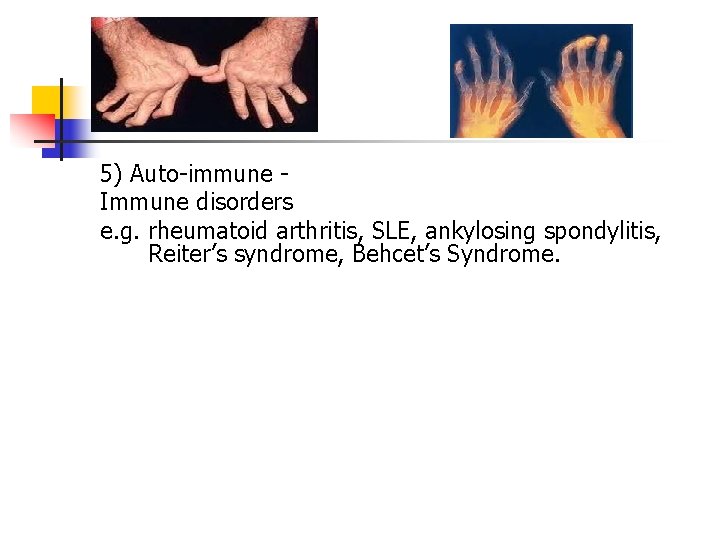 5) Auto-immune Immune disorders e. g. rheumatoid arthritis, SLE, ankylosing spondylitis, Reiter’s syndrome, Behcet’s 5) Auto-immune Immune disorders e. g. rheumatoid arthritis, SLE, ankylosing spondylitis, Reiter’s syndrome, Behcet’s