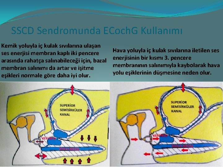 SSCD Sendromunda ECoch. G Kullanımı Kemik yoluyla iç kulak sıvılarına ulaşan ses enerjisi membran