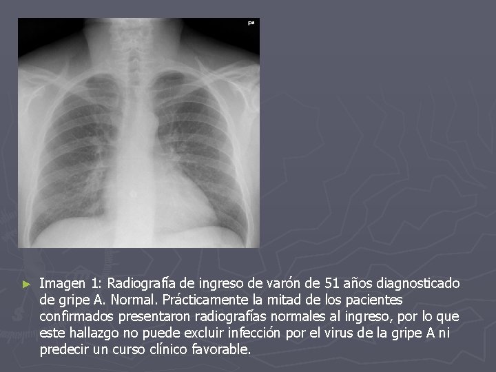 ► Imagen 1: Radiografía de ingreso de varón de 51 años diagnosticado de gripe