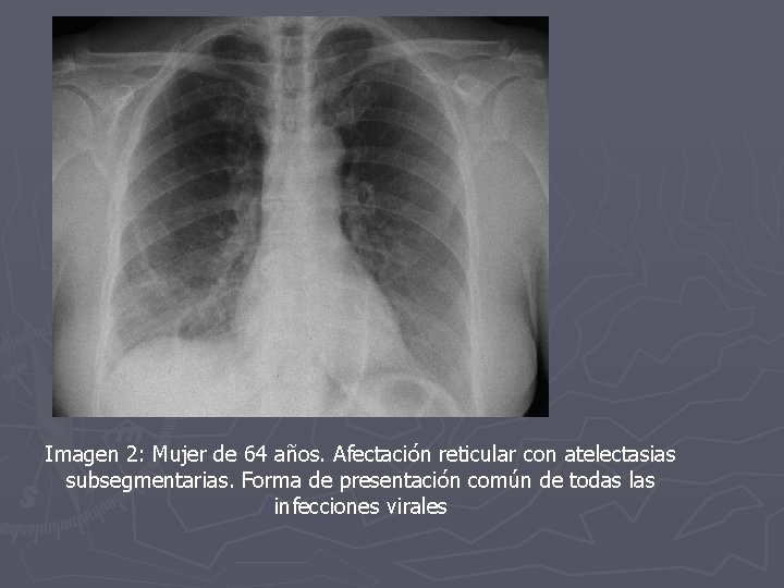 Imagen 2: Mujer de 64 años. Afectación reticular con atelectasias subsegmentarias. Forma de presentación